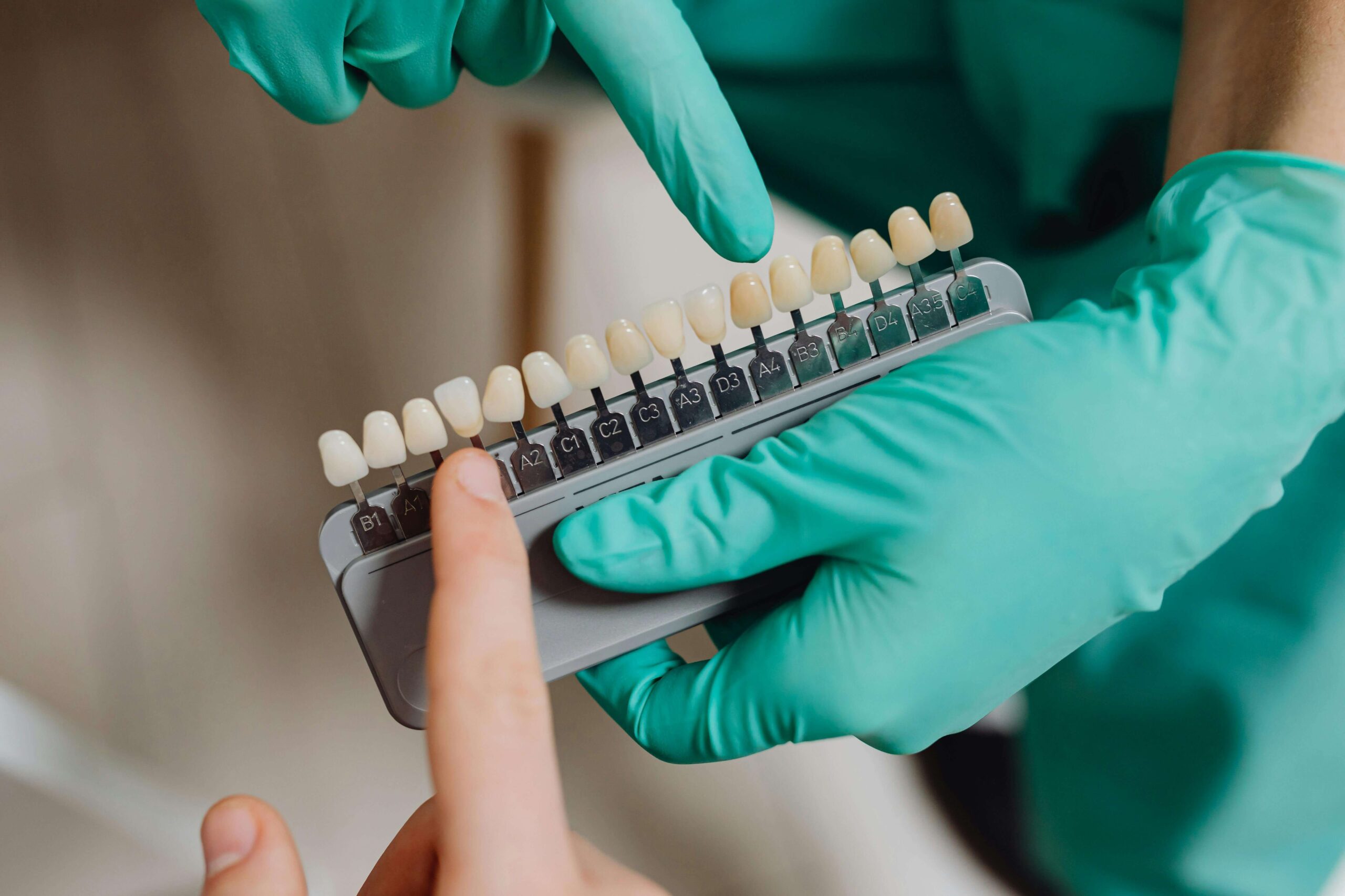 Levels of teeth staining and whitening Chinook mall Family Dental How to keep your teeth white