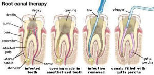 ROOT-canal-therapy-1