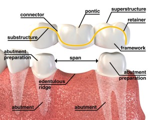 crown_and_bridge
