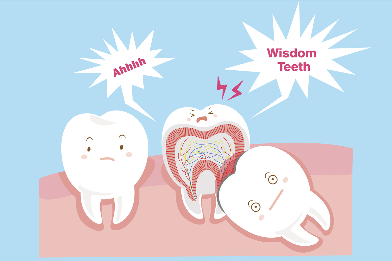 Wisdom Teeth- Is it Time? | Chinook Mall Family Dental Clinic