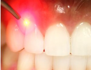 use-of-laser-in-dentistry